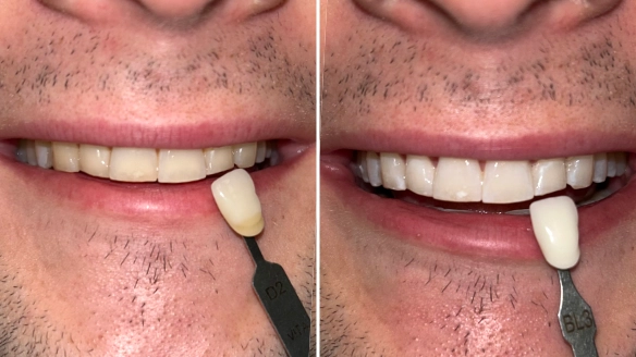 Zoom! Whitening